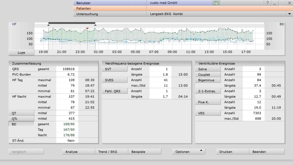Bildschirm mit der Software custo diagnostic tera von custo med, das die Ergebnisse der einer Kombimessung aus Langzeot-EKG und Langzeit-Blutdruckmessung zeigt